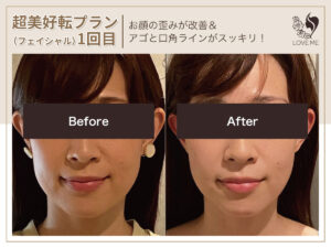 フェイシャルの施術ビフォーアフター 5