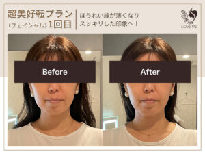 フェイシャルの施術ビフォーアフター 67