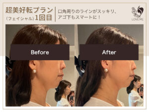 フェイシャルの施術ビフォーアフター 68
