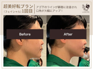 フェイシャルの施術ビフォーアフター 69