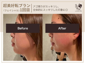フェイシャルの施術ビフォーアフター 72