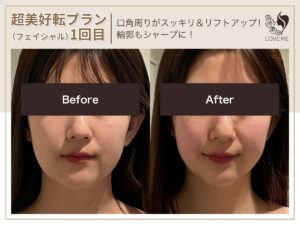 フェイシャルの施術ビフォーアフター 73
