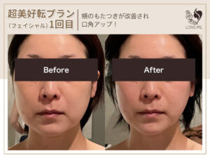 フェイシャルの施術ビフォーアフター 74