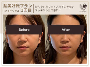 フェイシャルの施術ビフォーアフター 75
