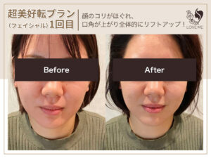 フェイシャルの施術ビフォーアフター 77