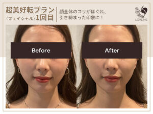 フェイシャルの施術ビフォーアフター 79