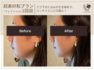 フェイシャルの施術ビフォーアフター 80