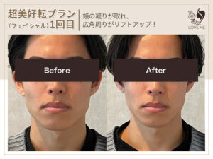 フェイシャルの施術ビフォーアフター 81