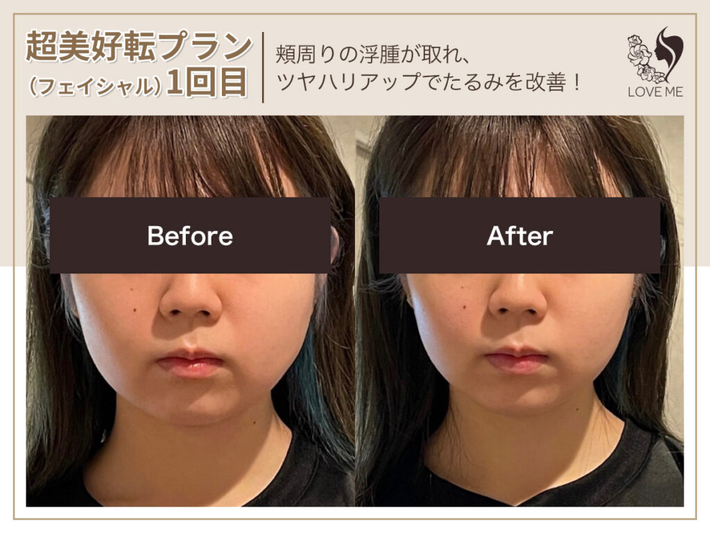 フェイシャルの施術ビフォーアフター 83