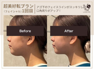 フェイシャルの施術ビフォーアフター 84