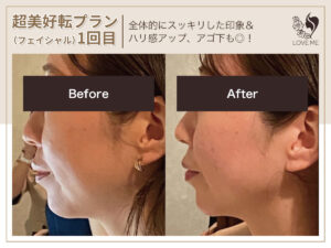 フェイシャルの施術ビフォーアフター 8