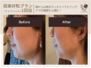 フェイシャルの施術ビフォーアフター 10