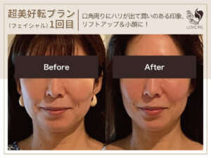 フェイシャルの施術ビフォーアフター 11