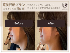 フェイシャルの施術ビフォーアフター 12