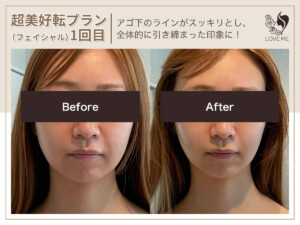 フェイシャルの施術ビフォーアフター 15