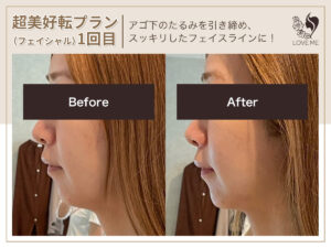 フェイシャルの施術ビフォーアフター 16