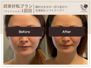 フェイシャルの施術ビフォーアフター 19