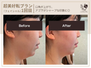 フェイシャルの施術ビフォーアフター 23