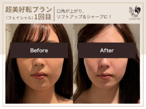 フェイシャルの施術ビフォーアフター 24