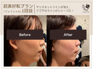 フェイシャルの施術ビフォーアフター 25