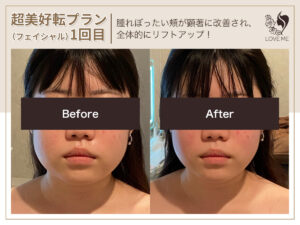 フェイシャルの施術ビフォーアフター 26