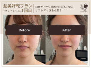 フェイシャルの施術ビフォーアフター 28