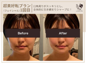 フェイシャルの施術ビフォーアフター 30