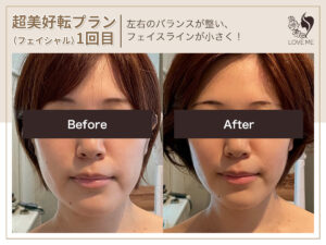 フェイシャルの施術ビフォーアフター 31