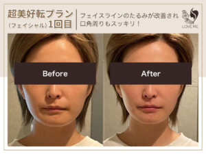 フェイシャルの施術ビフォーアフター 35