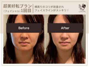 フェイシャルの施術ビフォーアフター 37