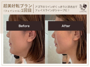 フェイシャルの施術ビフォーアフター 45