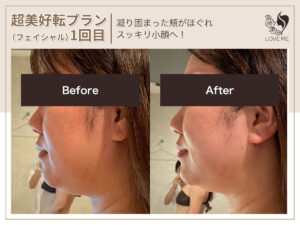 フェイシャルの施術ビフォーアフター 57
