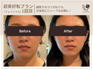 フェイシャルの施術ビフォーアフター 58