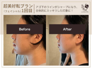 フェイシャルの施術ビフォーアフター 59