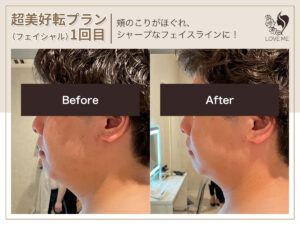 フェイシャルの施術ビフォーアフター 60