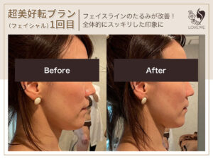 フェイシャルの施術ビフォーアフター 62