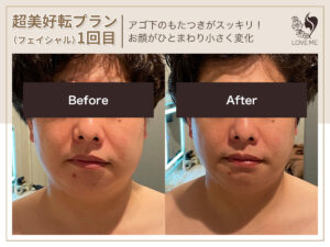 フェイシャルの施術ビフォーアフター 63