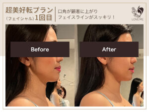 フェイシャルの施術ビフォーアフター 65